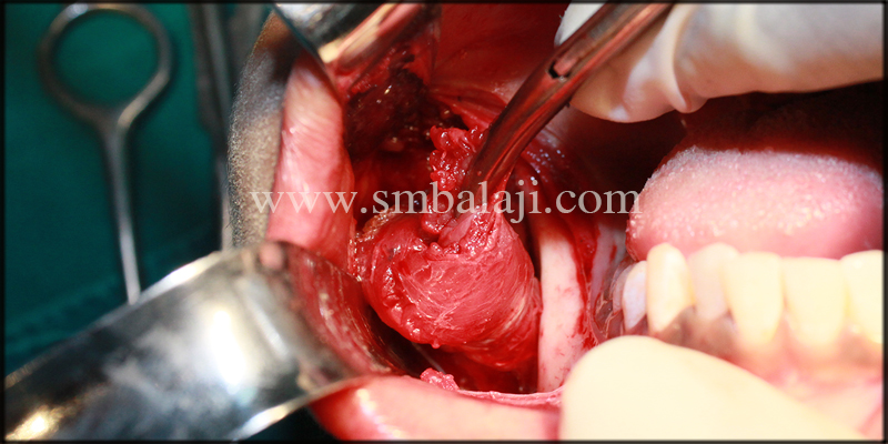 Intra-Operative View Showing Masseter Muscle Debulking On The Right Side