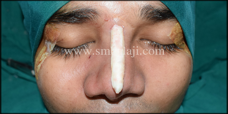 Lateral Osteotomy Done On Right Side To Straighten The Dorsum Of The Nose