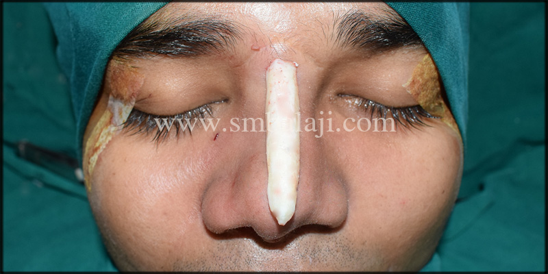 Lateral osteotomy done on right side to straighten the dorsum of the nose