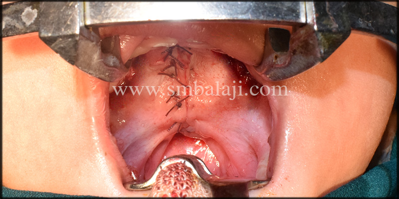 Post -Operative View Showing Cleft Palate Closure
