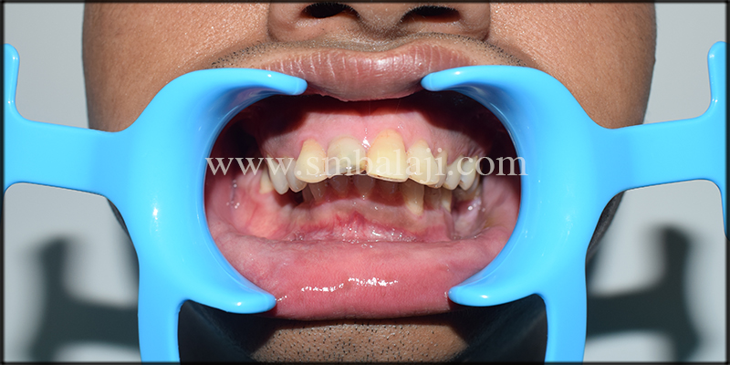 Pre-Operative Occlusal View Showing Increased Deep Bite