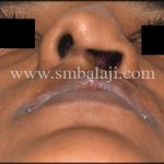 Worm'S Eye View Showing Ill-Defined Columella And Depressed Left Nostril