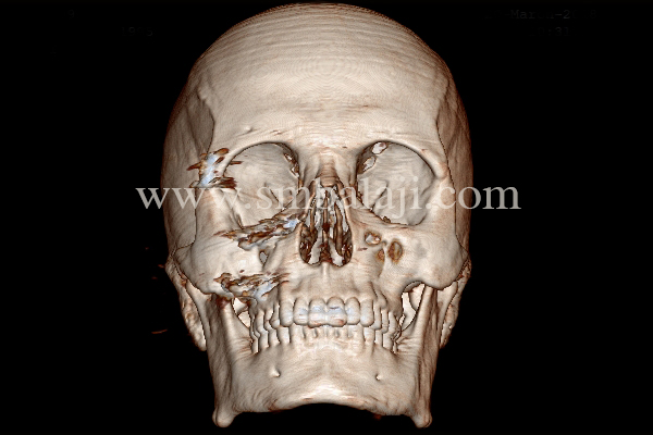 3Dct Scan Showing Depressed Right Zygoma