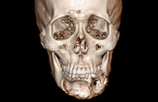 3DCT showing extensive loss of buccal cortex