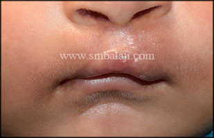 Immediately After Suture Removal, Seven Days After Surgery With Greatly Improved Appearance