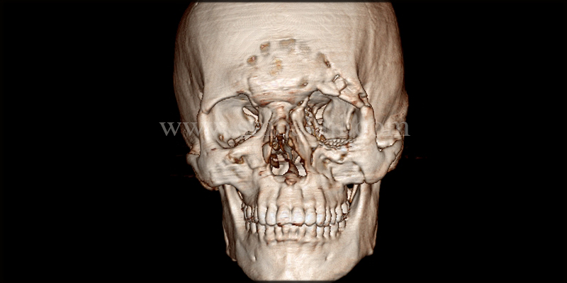 Malunited Zygomaticomaxillary Complex And Naso-Orbital Bone