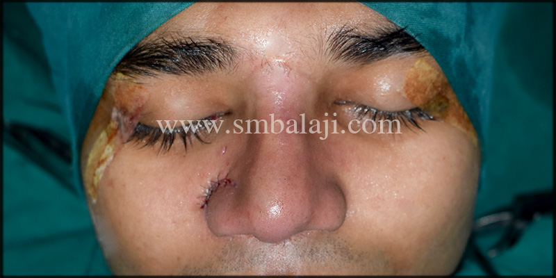 Nasal bridge elevated using costochondral rib graft and right ala elevated