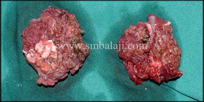 Operative View Showing Debulked Masseter Muscle