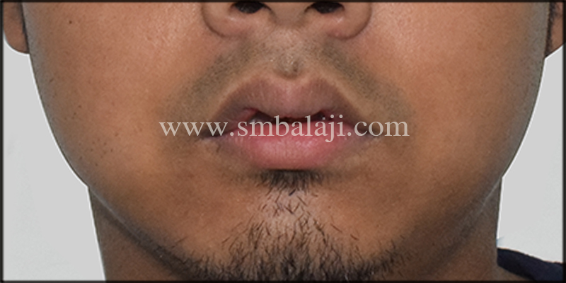 Post-Operative View Showing Corrected Maxillary Protrusion