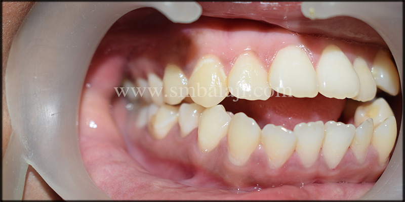 Pre-Operative Intra Oral View Showing Anterior Open Bite (Non-Occlusion)