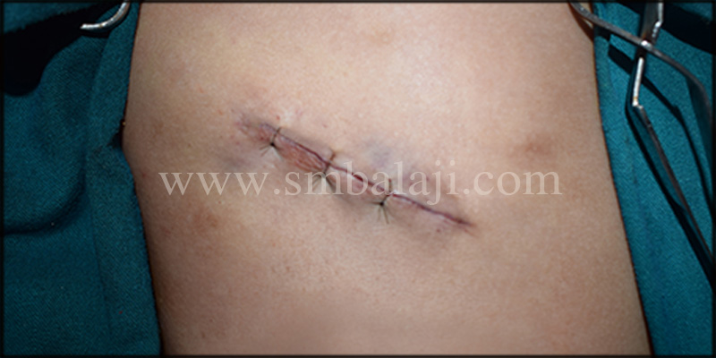 Costochondral Graft Site Immediately After Suturing