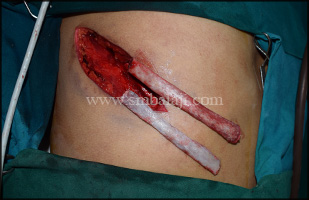 Costochondral Rib Graft Harvested To Reconstruct The Affected Portion Of Mandible