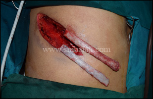 Costochondral rib graft harvested to reconstruct the affected portion of mandible