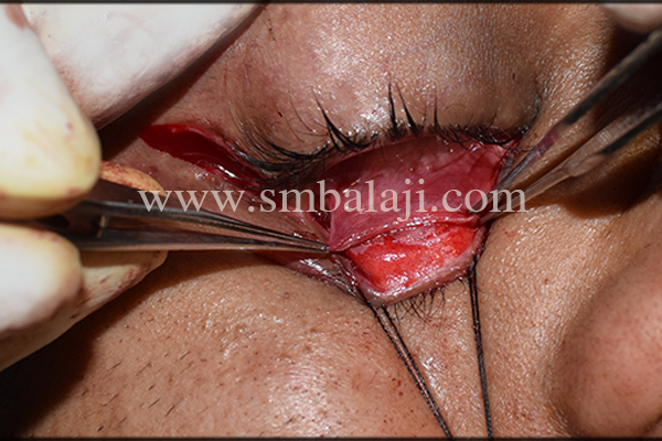 Eversion Of The Right Lower Eyelid Following Transconjunctival Incision