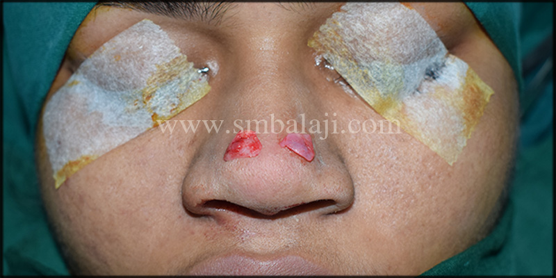 Operative View Showing Excised Bilateral Lateral Nasal Cartilage