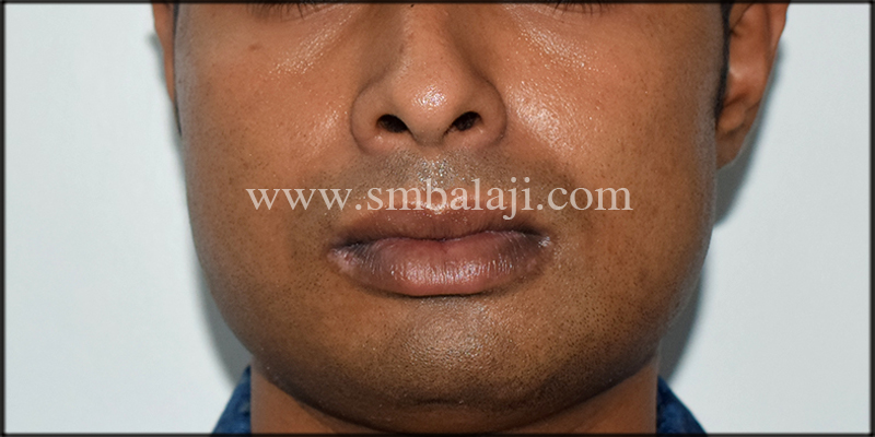 Post-Operative View Showing Improved Facial Profile
