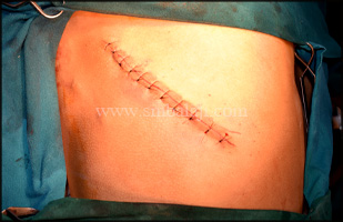 Costochondral graft site immediately after suturing