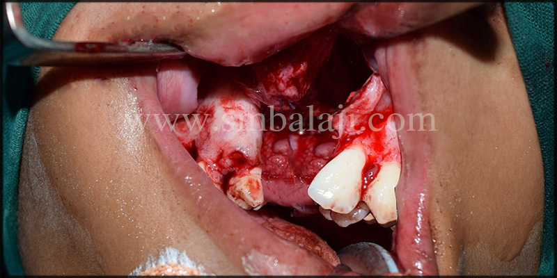 Gingivomucoperiosteal Flap Raised And The Alveolar Cleft Defect Was Exposed