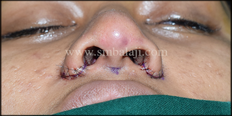 Immediately After Suturing Showing Broad Nose Correction Done By Weir Excision Showing Enhanced Appearence