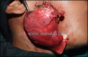 A Huge Expansile Bony Lesion Involving The Entire Right Ramus And Body Of The Mandible
