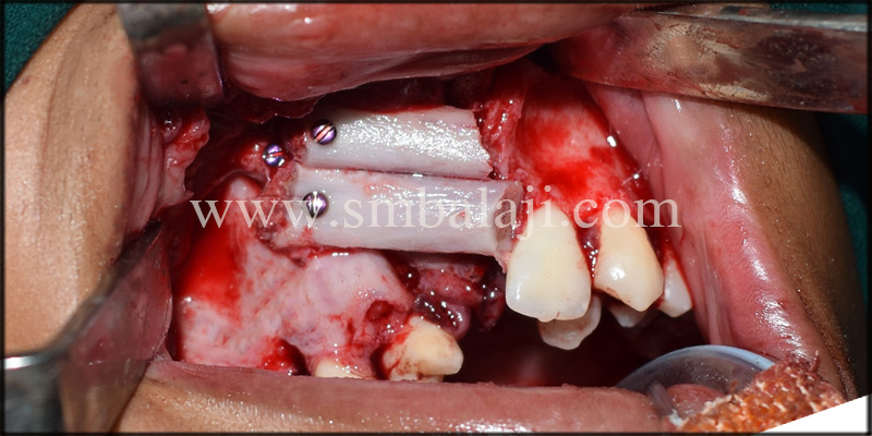 Alveolar Cleft Defect Reconstructed With Rib Graft