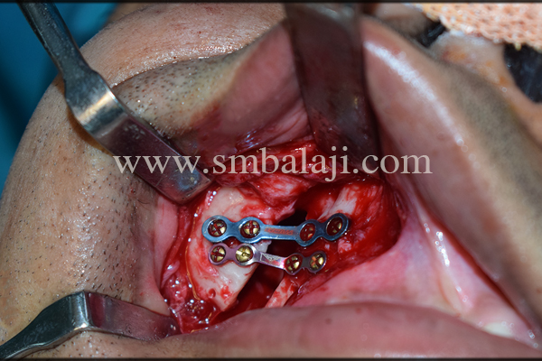 Right Zygoma Fracture Elevated And Fixed Using Ti Plates And Screws