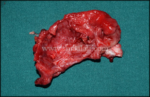 Infected portion of mandible removed