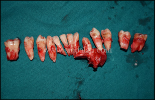 Cystic lesion along with the affected bone and teeth removed in toto