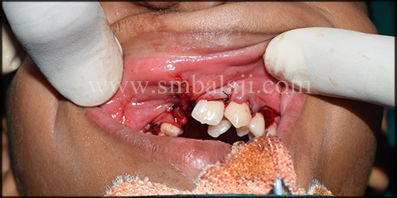 Alveolar Cleft Defect Site Immediately After Suturing
