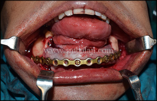 Harvested rib graft used to reconstruct the entire body of the mandible using Ti plates and screws