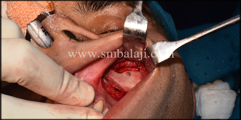 Left Maxillary Depression Augmented Using Cc Bone Graft