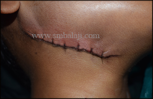 Immediately After Suturing