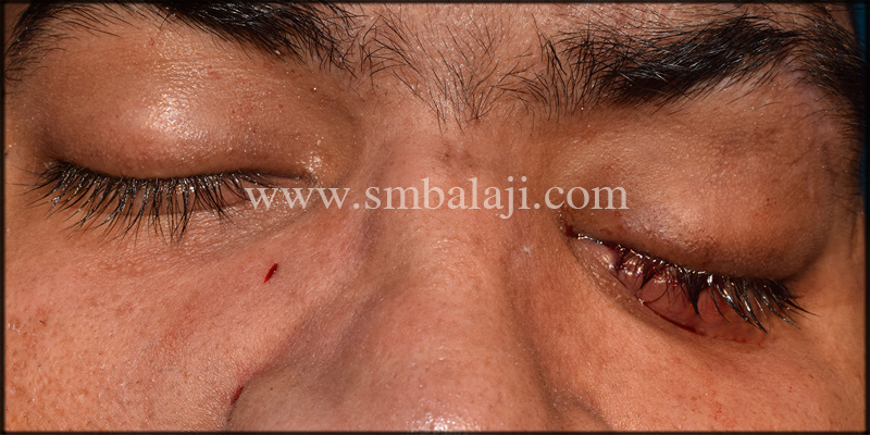 Lateral Osteotomy Done On Right Side Of The Nose