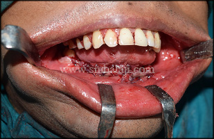 Suturing after surgical reconstruction of lower jaw