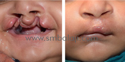 Bilateral Cleft Lip – Successful Primary Correction