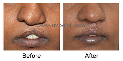 Depressed nose correction by closed rhinoplasty