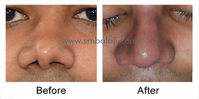 Deviated nose correction with cc graft