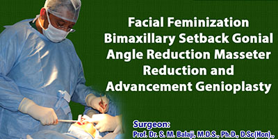 facial feminization surgery