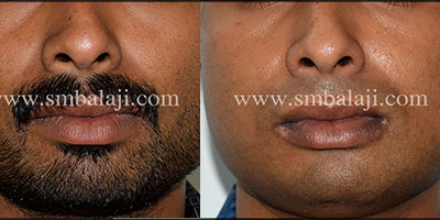 Improving facial profile by Masseter reduction