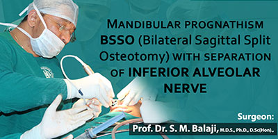 Mandibular Prognathism BSSO (Bilateral Sagittal Split Osteotomy)