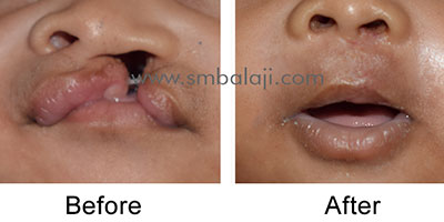 Primary lip repair for unilateral cleft lip and palate
