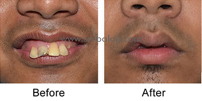 Profile enhancement by correction of upper jaw using AMO