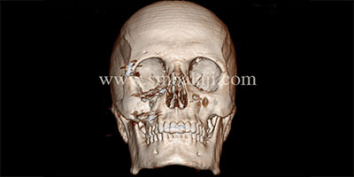 Successful surgical correction of diplopia and depressed zygoma