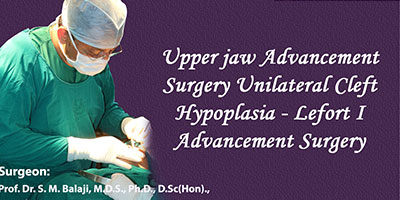 Upper jaw Advancement Surgery Unilateral Cleft Hypoplasia - Lefort 1 Advancement Surgery