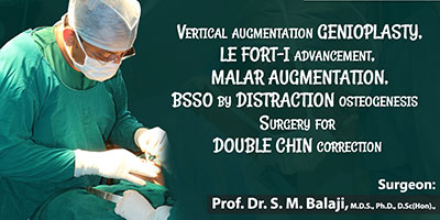 Vertical augmentation genioplasty, LeFort I advancement, malar augmentation, BSSO by Distraction Osteogenesis Surgery for Double Chin Correction