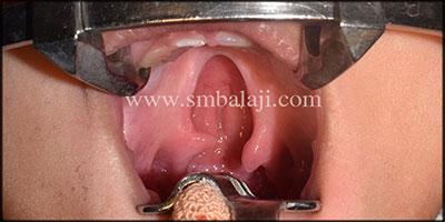 Successful cleft palate repair surgery with release of abnormal muscle attachment