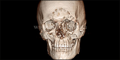 Successful correction of left side facial asymmetry due to RTA