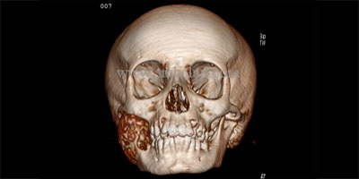 mandibular reconstruction