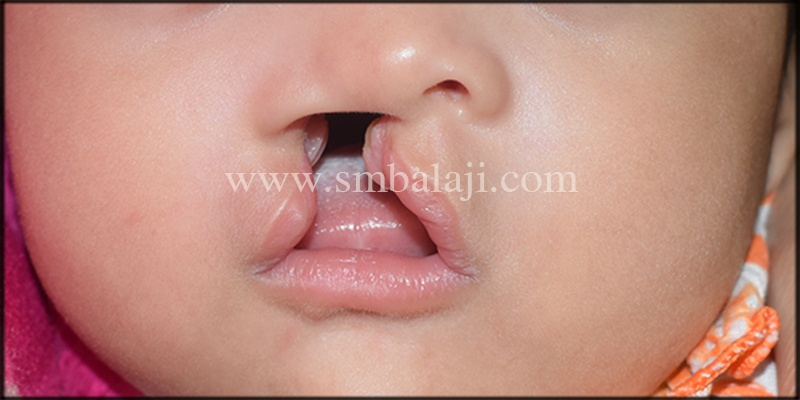 A 3-Month-Old Baby Born With Unilateral Cleft Lip And Palate