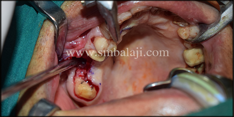 Pre-operative view depicting Oroantral fistula on the right side